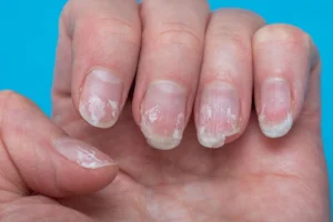 what your nails are trying to tell you about your health 2